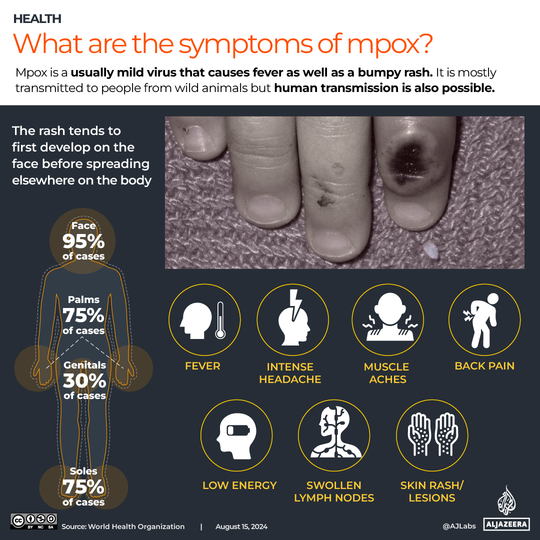 INTERACTIVE_MPOX August 19_2024_signs and symptoms REVISED