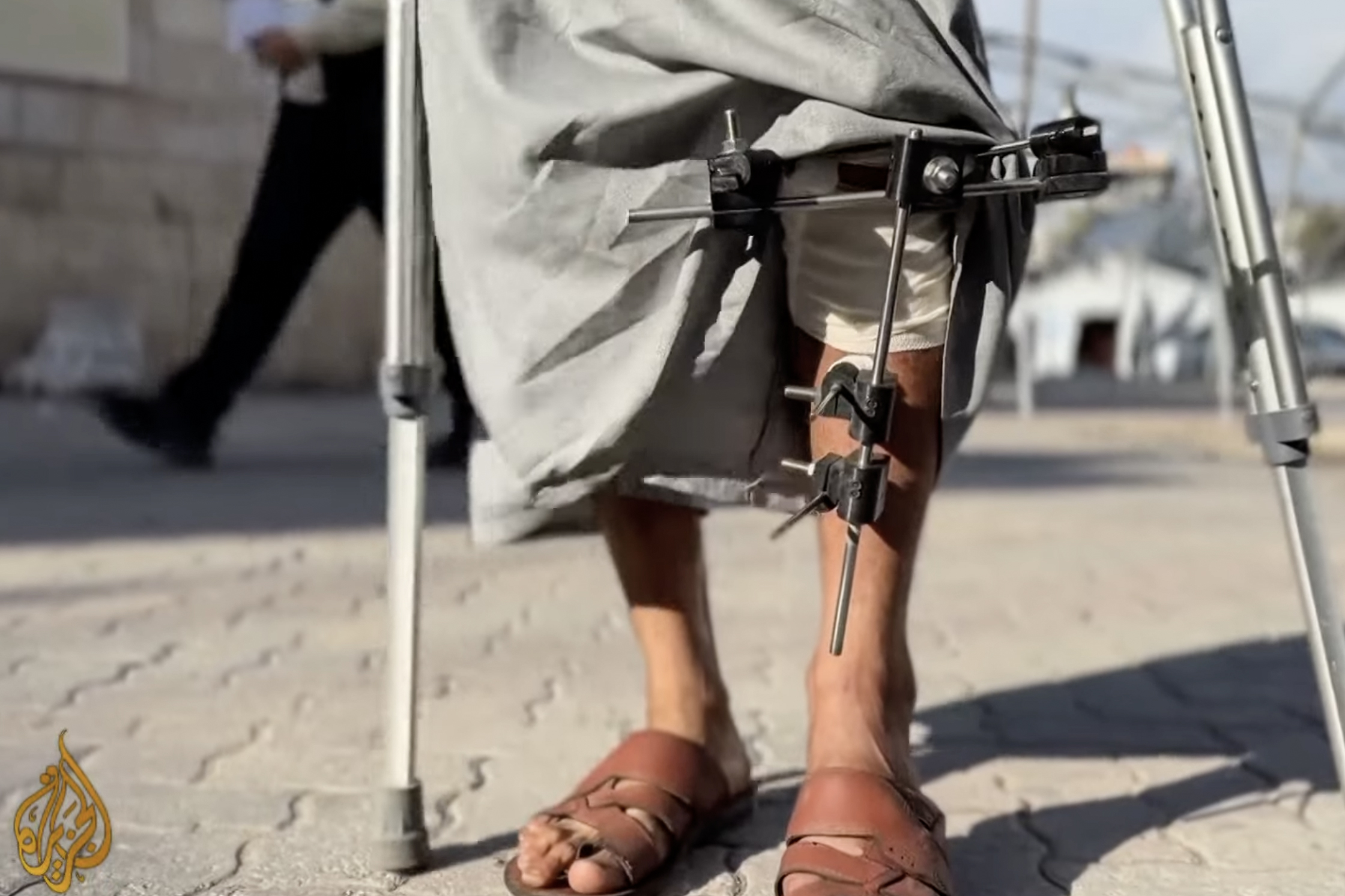 Gaza doctors use 3D