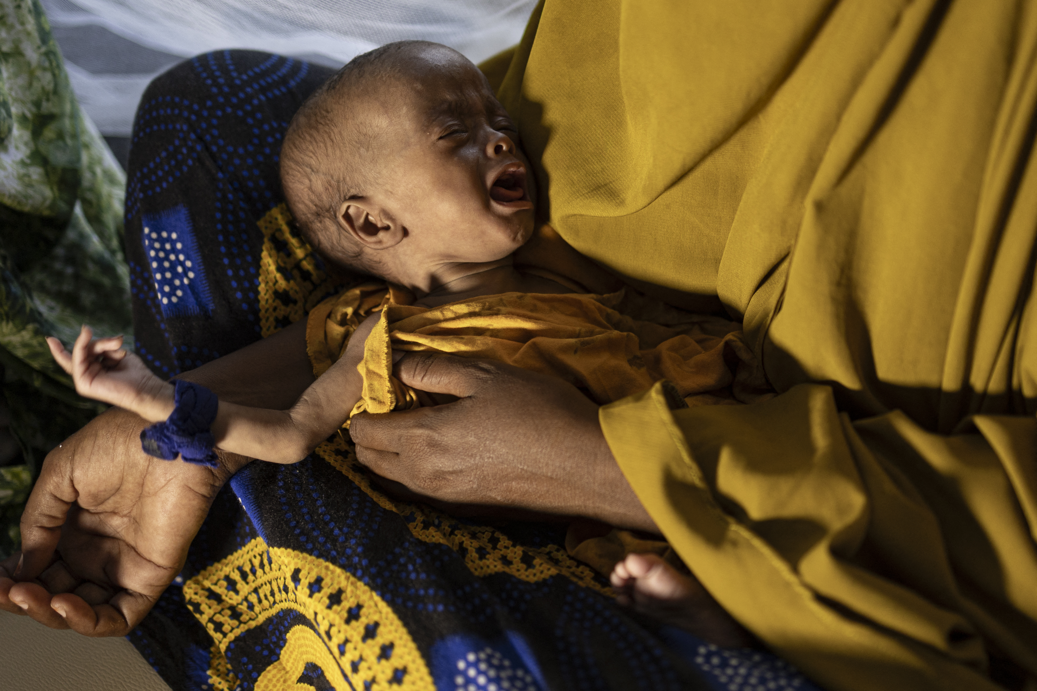 A newly displaced Somali woman holds her severely malnourished baby in a stabilization centre for children suffering severe accute malnutrition in Kismayo,